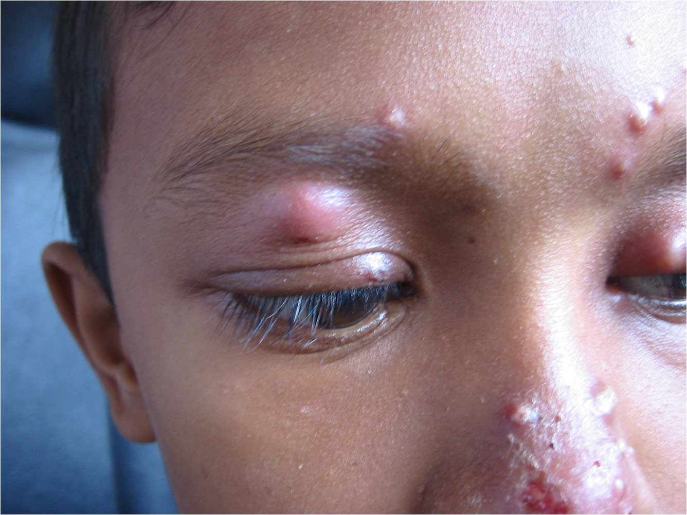 ABSCESS, BOILS AND SKIN INFECTIONS – Alkaline Healing Foods